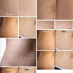 strivectin stretch mark cream before and after